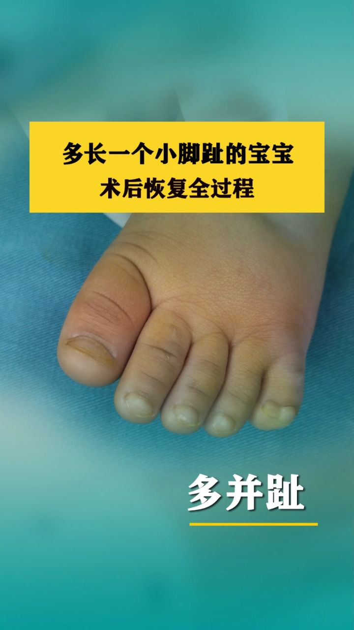 JJJ正式接受脚趾手术三个月后重新评估